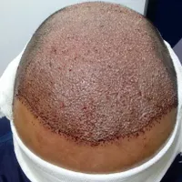 کاشت تخصصی مو و ابرو و ریش