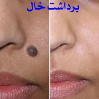 ژل لب مدل روسی و طبیعی بوتاکس میگرن مزوژل|خدمات آرایشگری و زیبایی|تهران, شاهین|دیوار