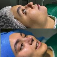 تیپ پلاستی (عمل بینی)
