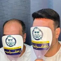 پروتزموترمیم مو پرپشتی مو در1جلسه|خدمات آرایشگری و زیبایی|اصفهان, نقش جهان|دیوار