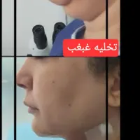 جشنواره تخلیه غبغب با تخفیف ویژه|خدمات آرایشگری و زیبایی|تهران, هاشمی|دیوار