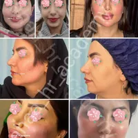 تزریق ژل بوتاکس چربی انزیم فیلر نخ پلکسر پلاسما|خدمات آرایشگری و زیبایی|مرودشت, ثبت احوال|دیوار