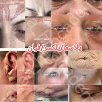 تزریق ژل بوتاکس چربی انزیم فیلر نخ پلکسر پلاسما|خدمات آرایشگری و زیبایی|مرودشت, ثبت احوال|دیوار