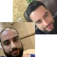 کاشت مو ابرو و ریش تارکوب