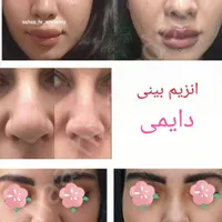 تزریق ژل بوتاکس چربی انزیم فیلر نخ پلکسر پلاسما|خدمات آرایشگری و زیبایی|مرودشت, ثبت احوال|دیوار