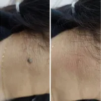 برداشتن خال وزیگیل در یک جلسه|خدمات آرایشگری و زیبایی|تهران, مسعودیه|دیوار