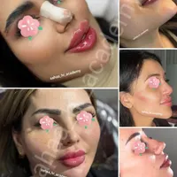 تزریق ژل بوتاکس چربی انزیم فیلر نخ پلکسر پلاسما|خدمات آرایشگری و زیبایی|مرودشت, ثبت احوال|دیوار