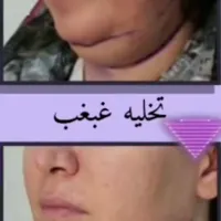 جشنواره تخلیه غبغب با تخفیف ویژه|خدمات آرایشگری و زیبایی|تهران, هاشمی|دیوار