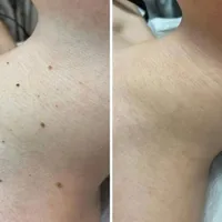 برداشتن خال وزیگیل در یک جلسه|خدمات آرایشگری و زیبایی|تهران, مسعودیه|دیوار