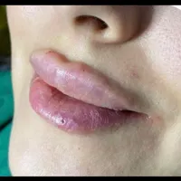 تزریق ژل بوتاکس و مزوژل واکسن زگیل|خدمات آرایشگری و زیبایی|تهران, شاهین|دیوار