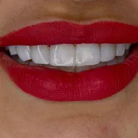 ایمپلنت کامپوزیت سفید کردن جرمگیری دندانپزشکی