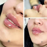 تزریق ژل و بوتاکس تخفیف بهاره ۳۹۹