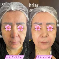 دو نفر مدل برای هایفوتراپی|خدمات آرایشگری و زیبایی|تهران, حکمت|دیوار