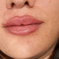 جشنواره بوتاکس مصپورت ۴۵۰ت فیلر ۵۵۰ت|خدمات آرایشگری و زیبایی|اصفهان, رزمندگان|دیوار