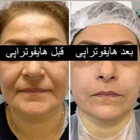 دو نفر مدل برای هایفوتراپی|خدمات آرایشگری و زیبایی|تهران, حکمت|دیوار