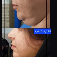 جشنواره تخلیه غبغب با تخفیف ویژه|خدمات آرایشگری و زیبایی|تهران, هاشمی|دیوار