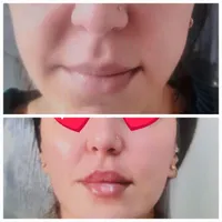 جشنواره بوتاکس مصپورت ۴۵۰ت فیلر ۵۵۰ت|خدمات آرایشگری و زیبایی|اصفهان, رزمندگان|دیوار