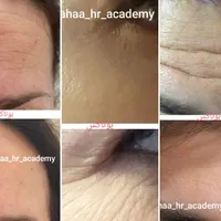 تزریق ژل بوتاکس چربی انزیم فیلر نخ پلکسر پلاسما|خدمات آرایشگری و زیبایی|مرودشت, ثبت احوال|دیوار