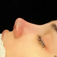 عمل جراحی زیبایی بینی و ترمیم بینی|خدمات آرایشگری و زیبایی|تهران, فلاح|دیوار