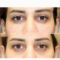 ژل زیرچشم شقیقه فیلر گودی چشم و شقیقه درمان گودی|خدمات آرایشگری و زیبایی|تهران, صادقیه|دیوار