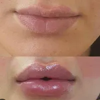 لیزر موی زاید بوتاکس هایفو ژل پی ارپی فشیال|خدمات آرایشگری و زیبایی|تهران, هاشمی|دیوار