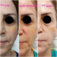 هایفو 7d،هایفوتراپی تخصصی، لیفت جوانسازی رفع غبغب