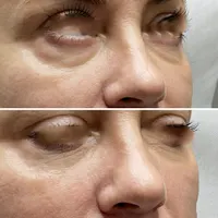 ژل زیرچشم شقیقه فیلر گودی چشم و شقیقه درمان گودی|خدمات آرایشگری و زیبایی|تهران, صادقیه|دیوار