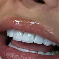 دندان پزشکی زیبایی لبخند خاص کامپوزیت ونیر لیرینیگ|خدمات آرایشگری و زیبایی|تهران, افسریه|دیوار