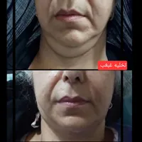 جشنواره تخلیه غبغب با تخفیف ویژه|خدمات آرایشگری و زیبایی|تهران, هاشمی|دیوار