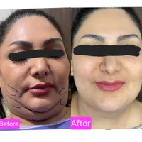 جشنواره تخلیه غبغب با تخفیف ویژه|خدمات آرایشگری و زیبایی|تهران, هاشمی|دیوار