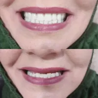 انجام کلیه خدمات دندان مصنوعی|خدمات آرایشگری و زیبایی|تربت‌حیدریه, |دیوار
