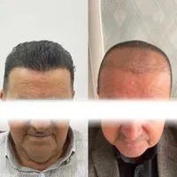 کاشت مو ابرو و ریش تارکوب