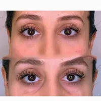 ژل زیرچشم شقیقه فیلر گودی چشم و شقیقه درمان گودی|خدمات آرایشگری و زیبایی|تهران, صادقیه|دیوار