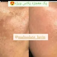 آموزش تخصصی کرم ضدلک وجوش|خدمات آموزشی|بوکان, |دیوار