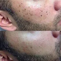 برداشتن خال وزیگیل در یک جلسه|خدمات آرایشگری و زیبایی|تهران, مسعودیه|دیوار