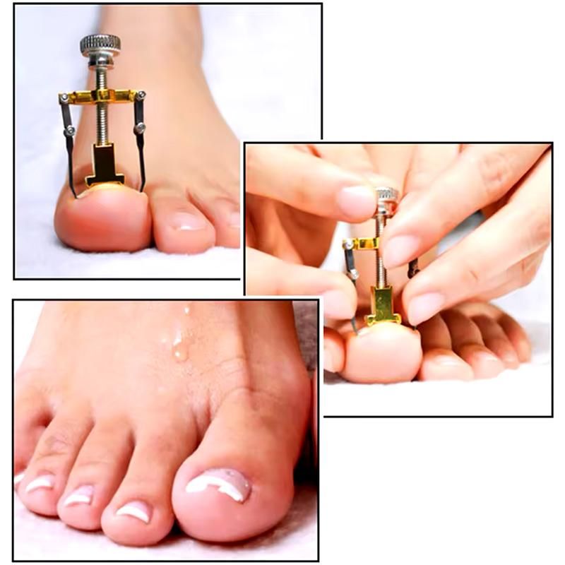 دستگاه اصلاح فرم و ارتودنسی ناخن مدل Nails|آرایشی، بهداشتی، درمانی|تهران, آرژانتین|دیوار