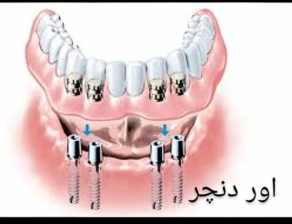 ساخت دندان مصنوعی هر فک فقط دو میلیون|خدمات آرایشگری و زیبایی|تهران, شمشیری|دیوار