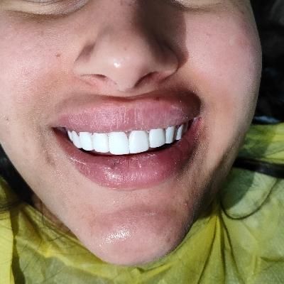کامپوزیت دندان فقط 8500هر فک نقد و چک|خدمات آرایشگری و زیبایی|رشت, گلسار|دیوار