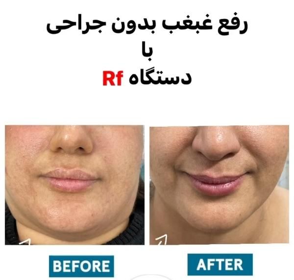 ژل لب گونه چانه لیزر رفع لک بوتاکس لاغری|خدمات آرایشگری و زیبایی|تهران, هفت حوض|دیوار