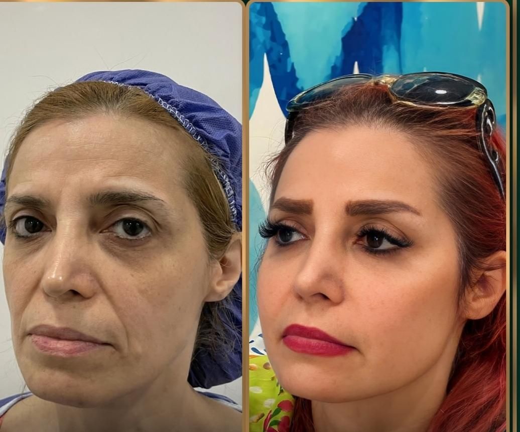 تز ریق چربی صورت بلفارو|خدمات آرایشگری و زیبایی|اصفهان, احمدآباد|دیوار