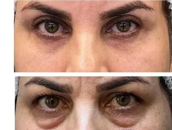 بلفارو پلاستی (بخیه لیزری)|خدمات آرایشگری و زیبایی|مشهد, دانشجو|دیوار