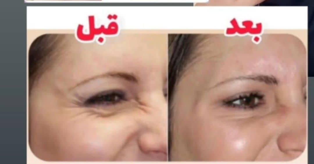 درمان چین و چروک|خدمات آرایشگری و زیبایی|جوادآباد, |دیوار