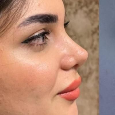 عمل بینی/سانترال لب/بلفارو پلاستی|خدمات آرایشگری و زیبایی|مشهد, احمدآباد|دیوار