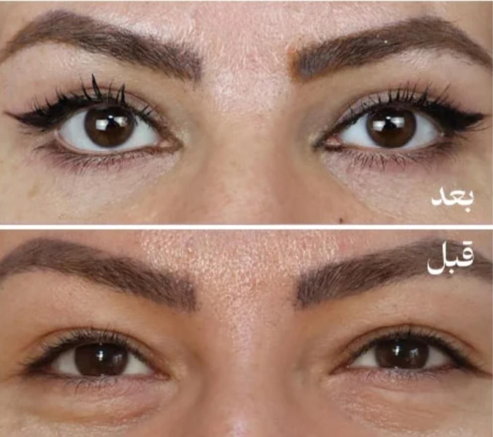 بلفارو پلاستی (بخیه لیزری)|خدمات آرایشگری و زیبایی|مشهد, دانشجو|دیوار