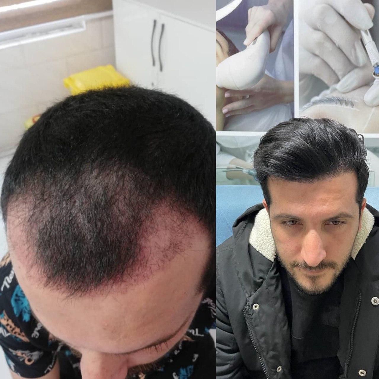 کاشت مو تبریز|خدمات آرایشگری و زیبایی|مرند, |دیوار
