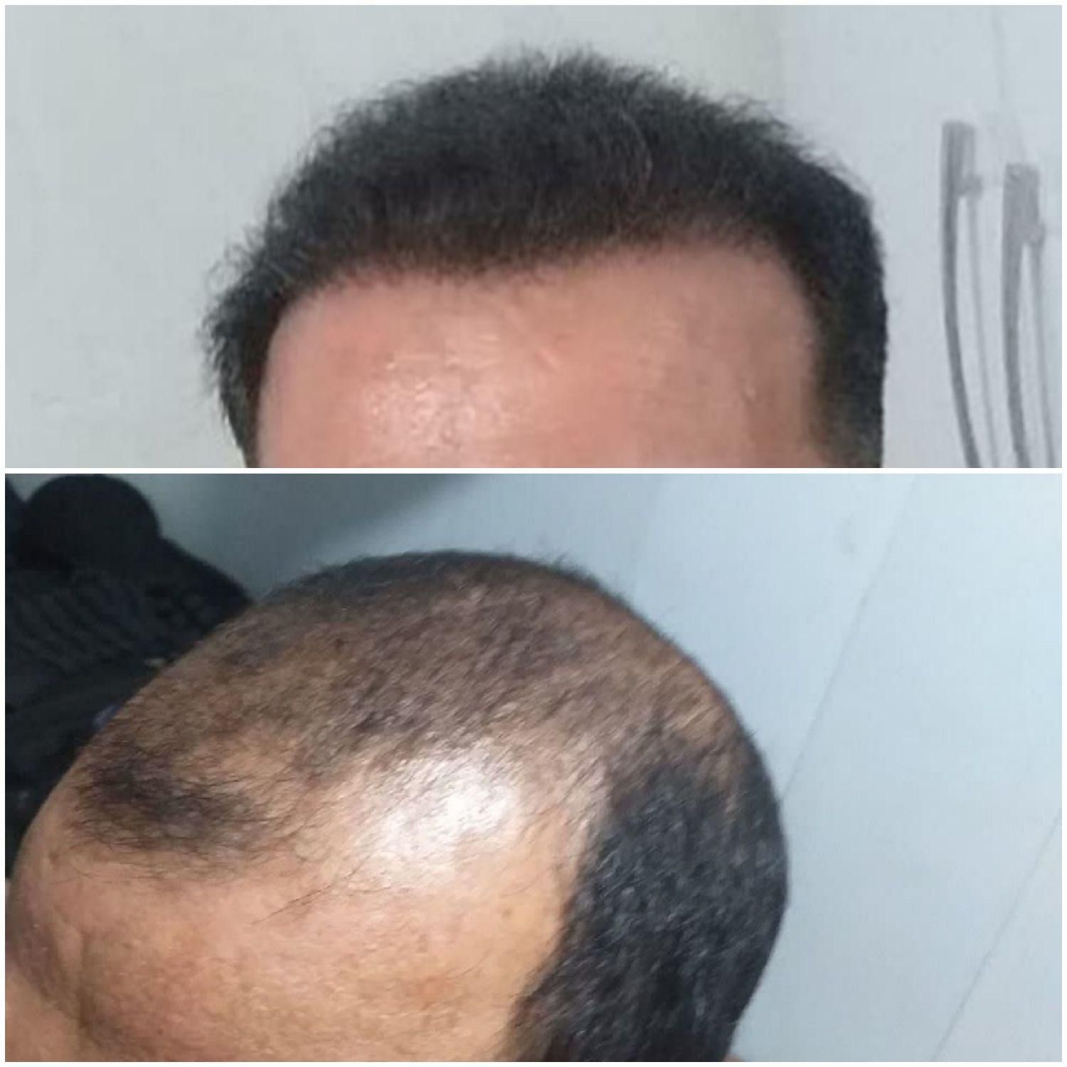 کاشت موی طبیعی سبک شیرازی|خدمات آرایشگری و زیبایی|تهران, زعفرانیه|دیوار