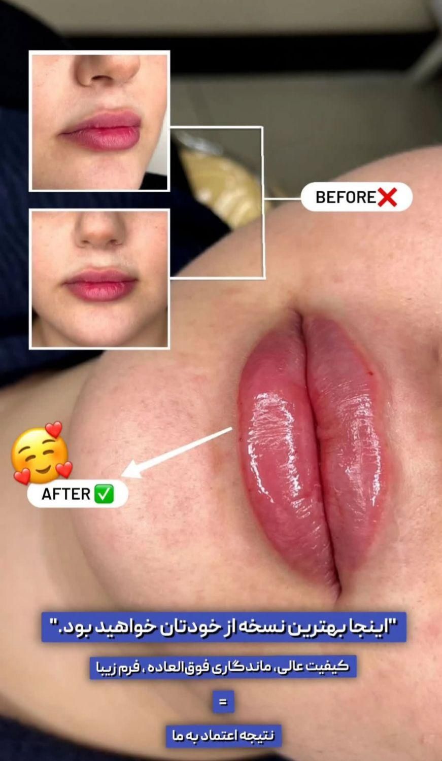 مدل تزریقات ژل و بوتاکس و خدمات پزشکی|خدمات آرایشگری و زیبایی|تهران, صادقیه|دیوار