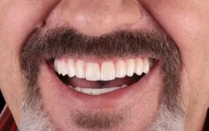 ایمپلنت درجه یک/اقساطی/بدون پیش پرداخت /تخفیف|خدمات آرایشگری و زیبایی|تهران, شهرک غرب|دیوار
