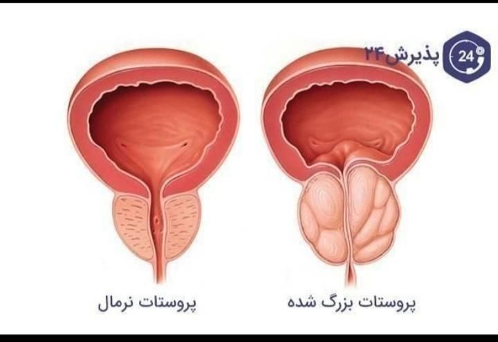 درمان قطعی وریشه ای پروستات|خدمات آرایشگری و زیبایی|تهران, یوسف‌آباد|دیوار