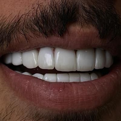 کامپوزیت دندان،لمینیت،روکش،عصب کشی|خدمات آرایشگری و زیبایی|تهران, شهرک غرب|دیوار